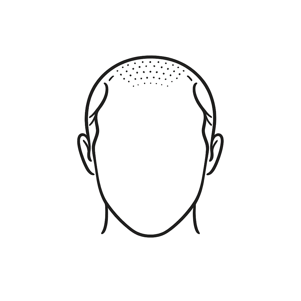 Male head outline illustration showing androgenetic alopecia pattern baldness