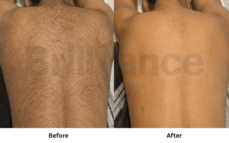 leaser hair removal