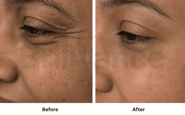 Before and after Botox treatment for frown lines between the eyebrows in Mumbai
