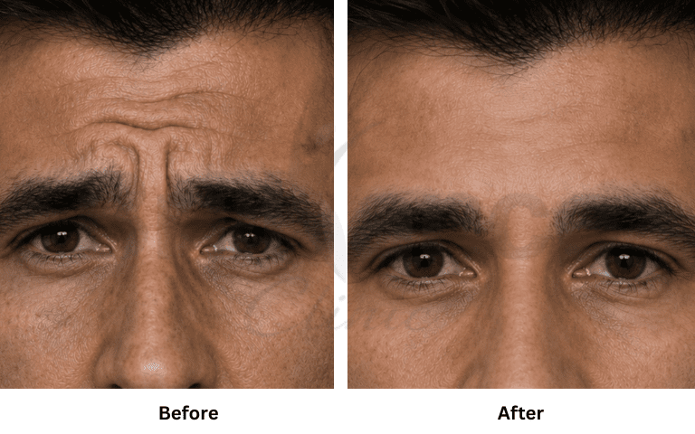 Botox combination wrinkle reduction result – forehead, frown lines and crow's feet Mumbai