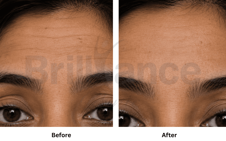 Botox before and after showing forehead line smoothing at Brilliance Cosmocare Mumbai