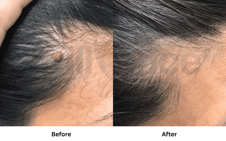 profhilo-skin-texture-hydration-improvement-results-mumbai (39)