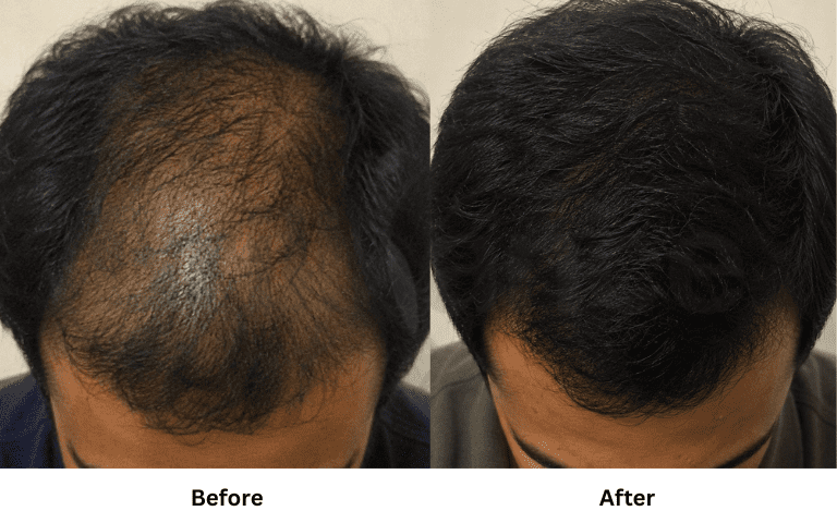 Top-down crown view showing male pattern baldness before and denser regrowth after treatment