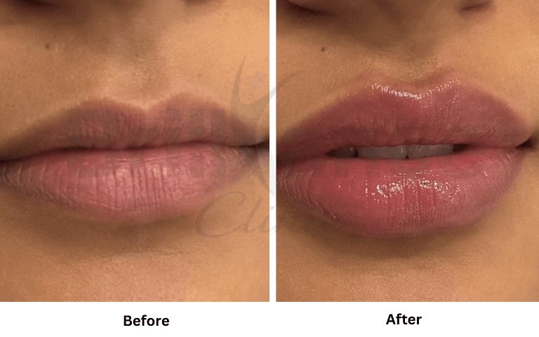 profhilo-skin-texture-hydration-improvement-results-mumbai (45)