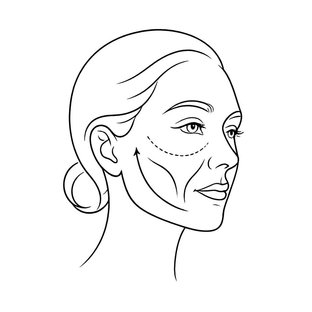 Line-art icon depicting nasolabial fold correction using dermal filler injection