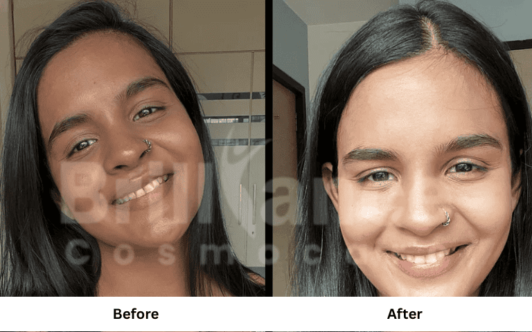 Chemical Peel Treatment