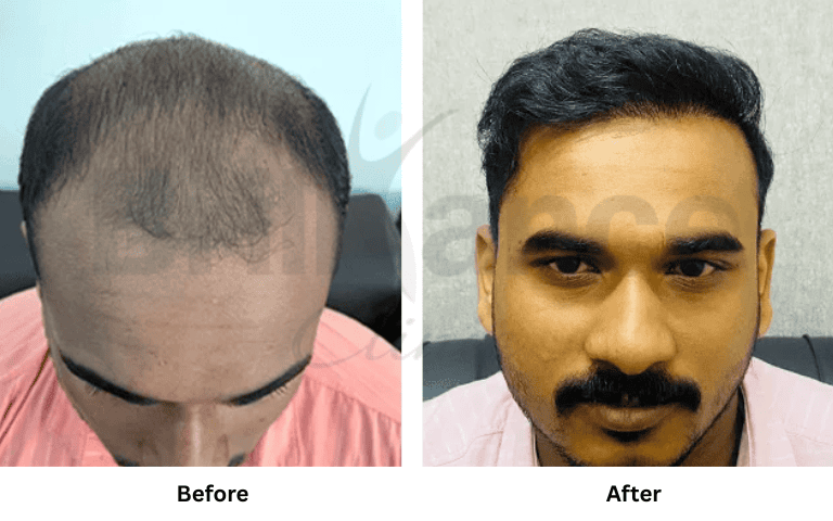 before & after of treatments (33)
