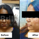 Before and After Brilliance Cosmocare Patient 1