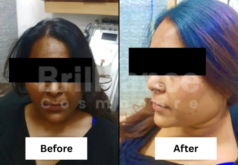 Before and After Brilliance Cosmocare Patient 1