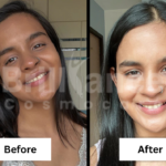 Before and After Brilliance Cosmocare Patient 2