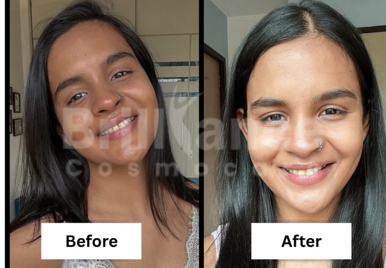 Before and After Brilliance Cosmocare Patient 2