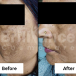 Before and After Brilliance Cosmocare Patient 3