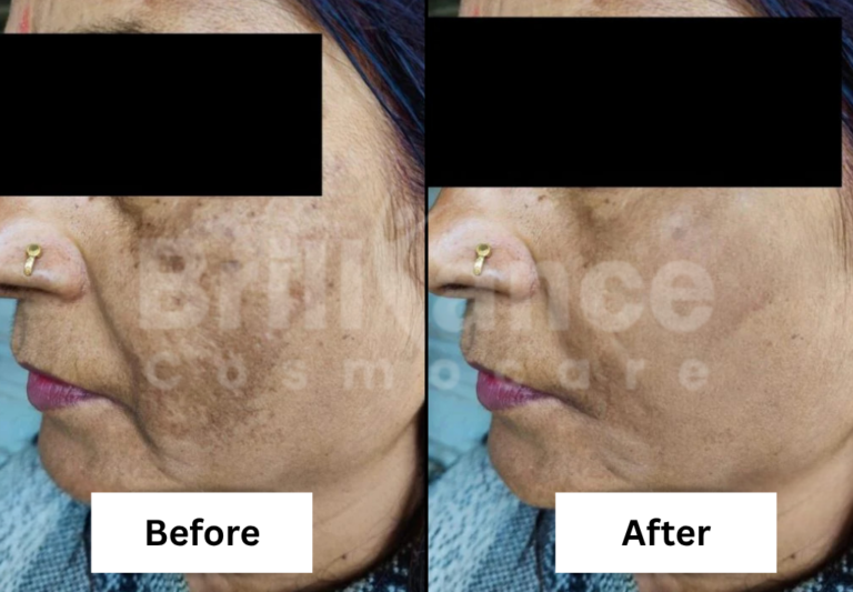 Before and After Brilliance Cosmocare Patient 3