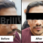 Before and After Brilliance Cosmocare Patient 4