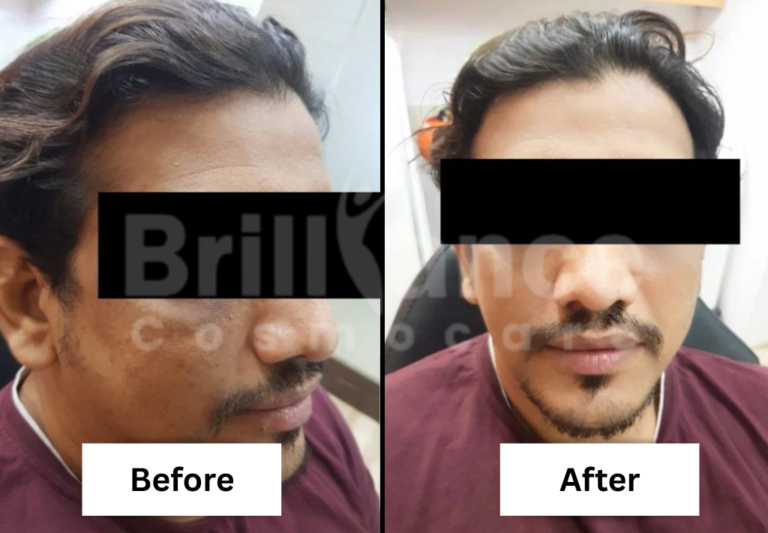 Before and After Brilliance Cosmocare Patient 4