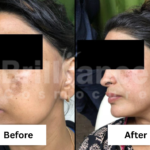 Before and After Brilliance Cosmocare Patient 6