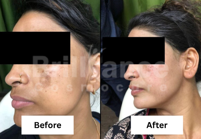 Before and After Brilliance Cosmocare Patient 6