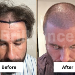 Before and After Brilliance Cosmocare Patient 7 (1)