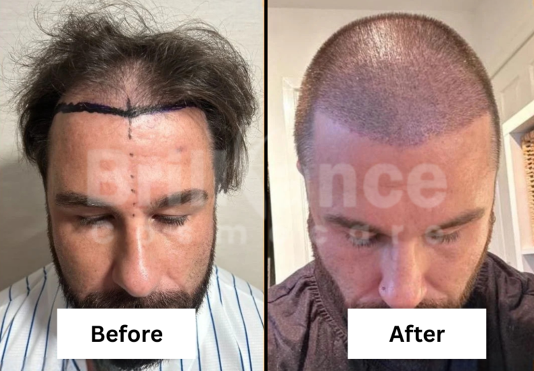 Before and After Brilliance Cosmocare Patient 7 (1)