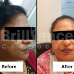 Before and After Brilliance Cosmocare Patient 8 (1)