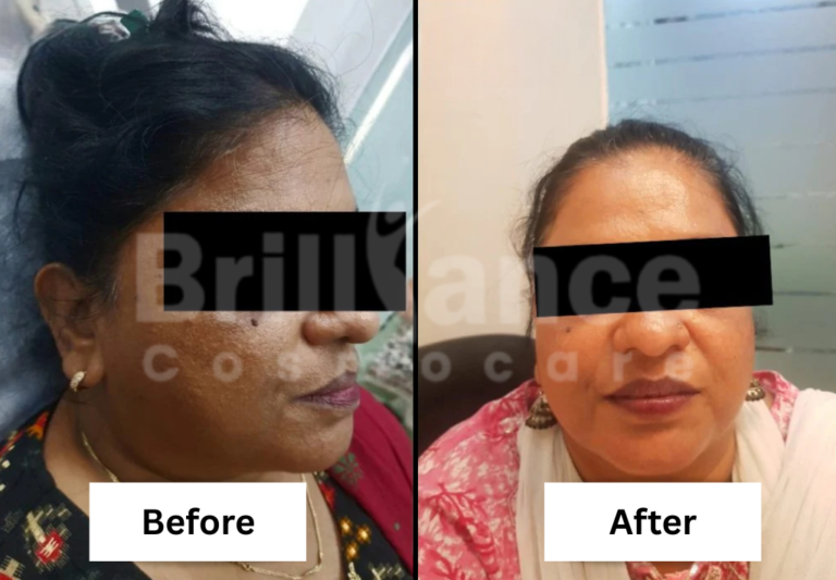 Before and After Brilliance Cosmocare Patient 8 (1)