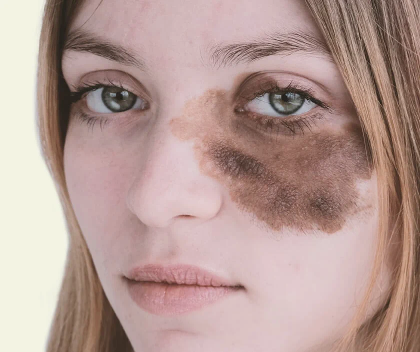 Birthmark Removal