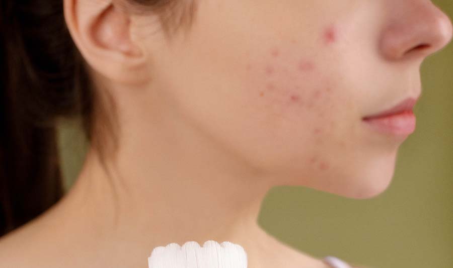 Acne on Cheeks