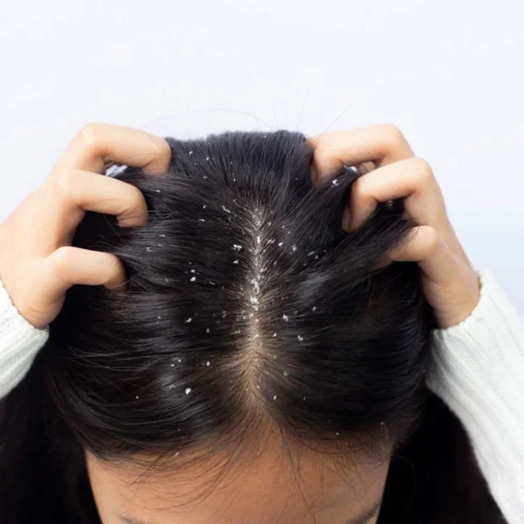 Anti-Dandruff Treatment