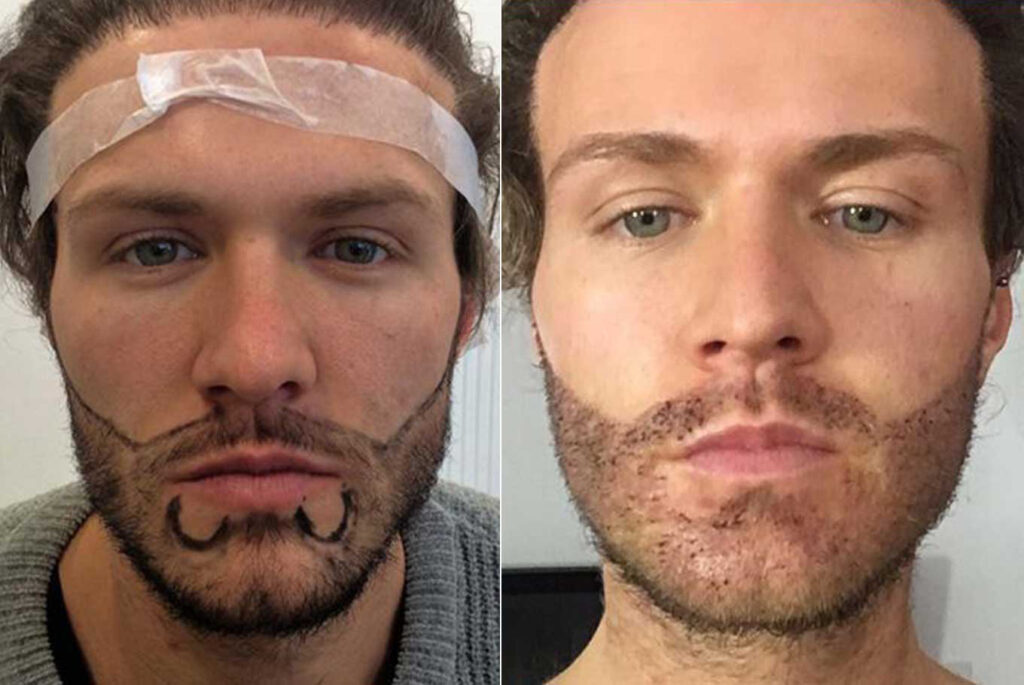 Beard Hair Transplant