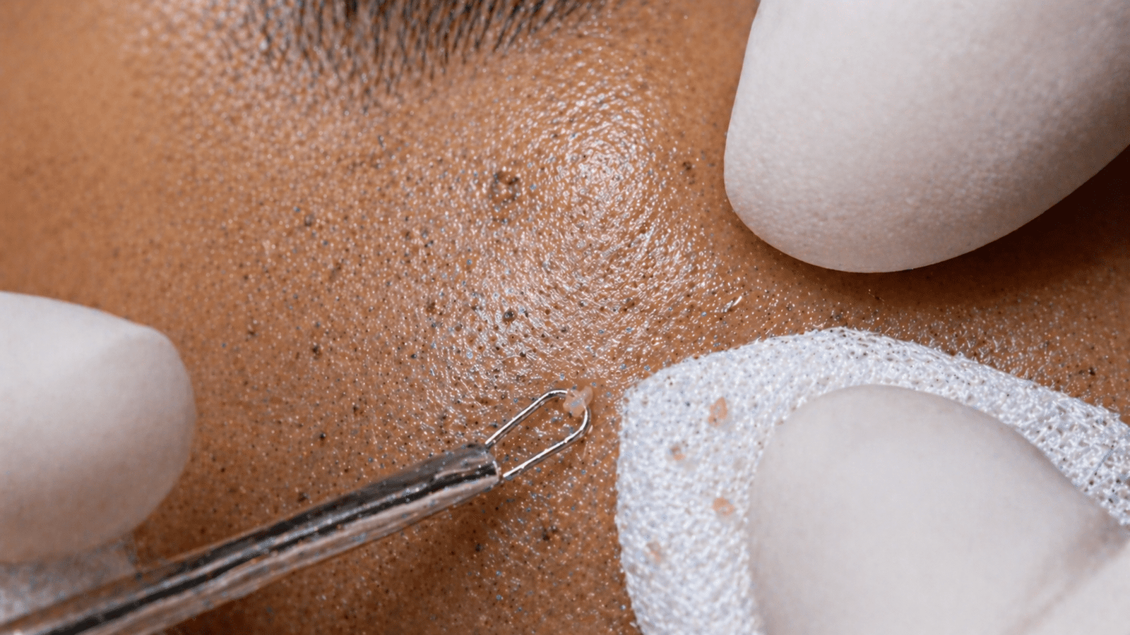Medi facial clinical pore cleansing on Indian skin using professional technique at Brilliance Cosmocare Skin, Hair and Weightloss Clinic