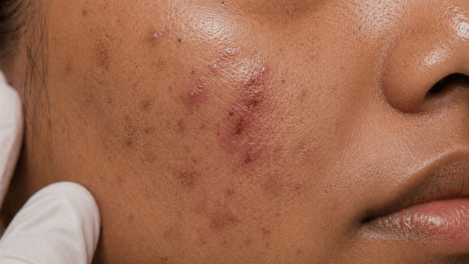 Indian skin with active acne infection or open skin requiring medical consultation before treatment at Brilliance Cosmocare Skin, Hair and Weightloss Clinic in Mumbai, India