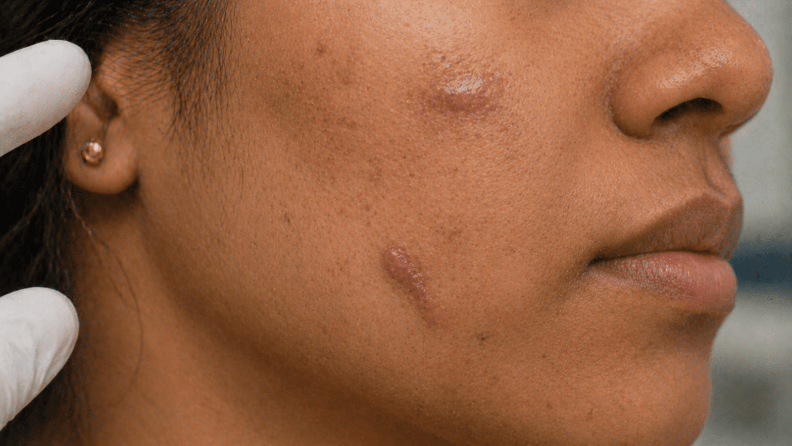 Indian skin prone to keloid scarring requiring careful acne treatment evaluation at Brilliance Cosmocare Skin, Hair and Weightloss Clinic in Mumbai, India