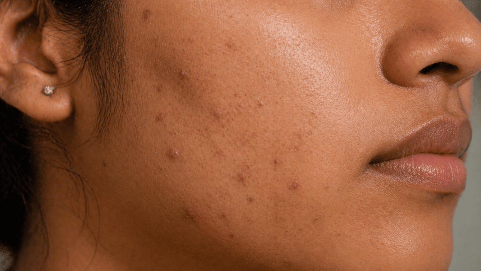 Early acne treatment reducing redness and inflammation on Indian skin at Brilliance Cosmocare Skin, Hair and Weightloss Clinic in Mumbai, India