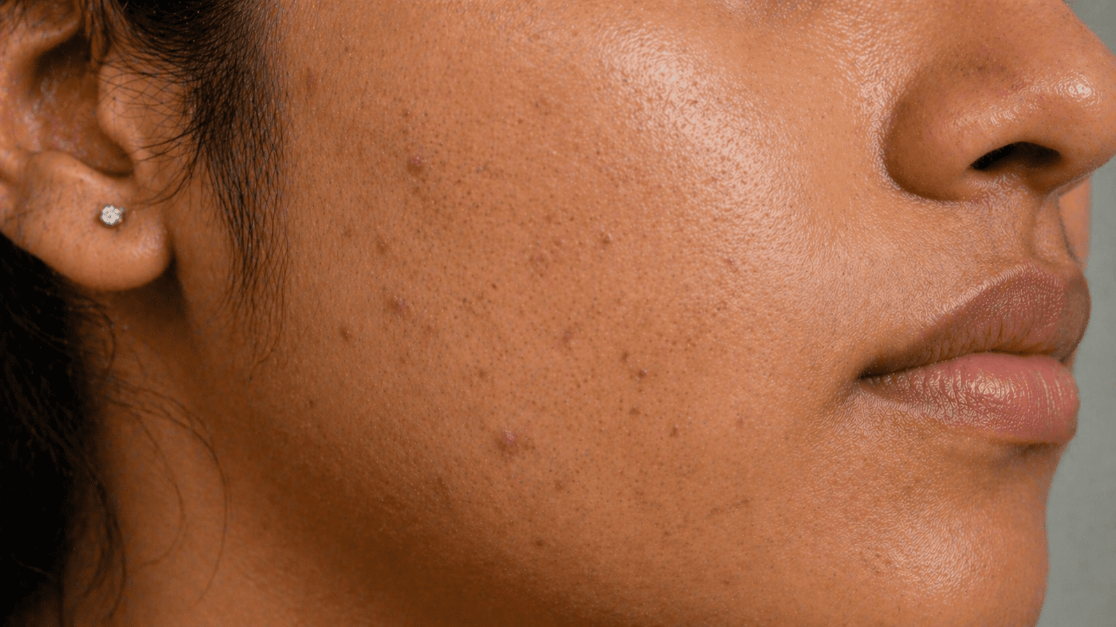 Reduced acne breakouts improved texture and oil control on Indian skin during treatment at Brilliance Cosmocare Skin, Hair and Weightloss Clinic in Mumbai, India