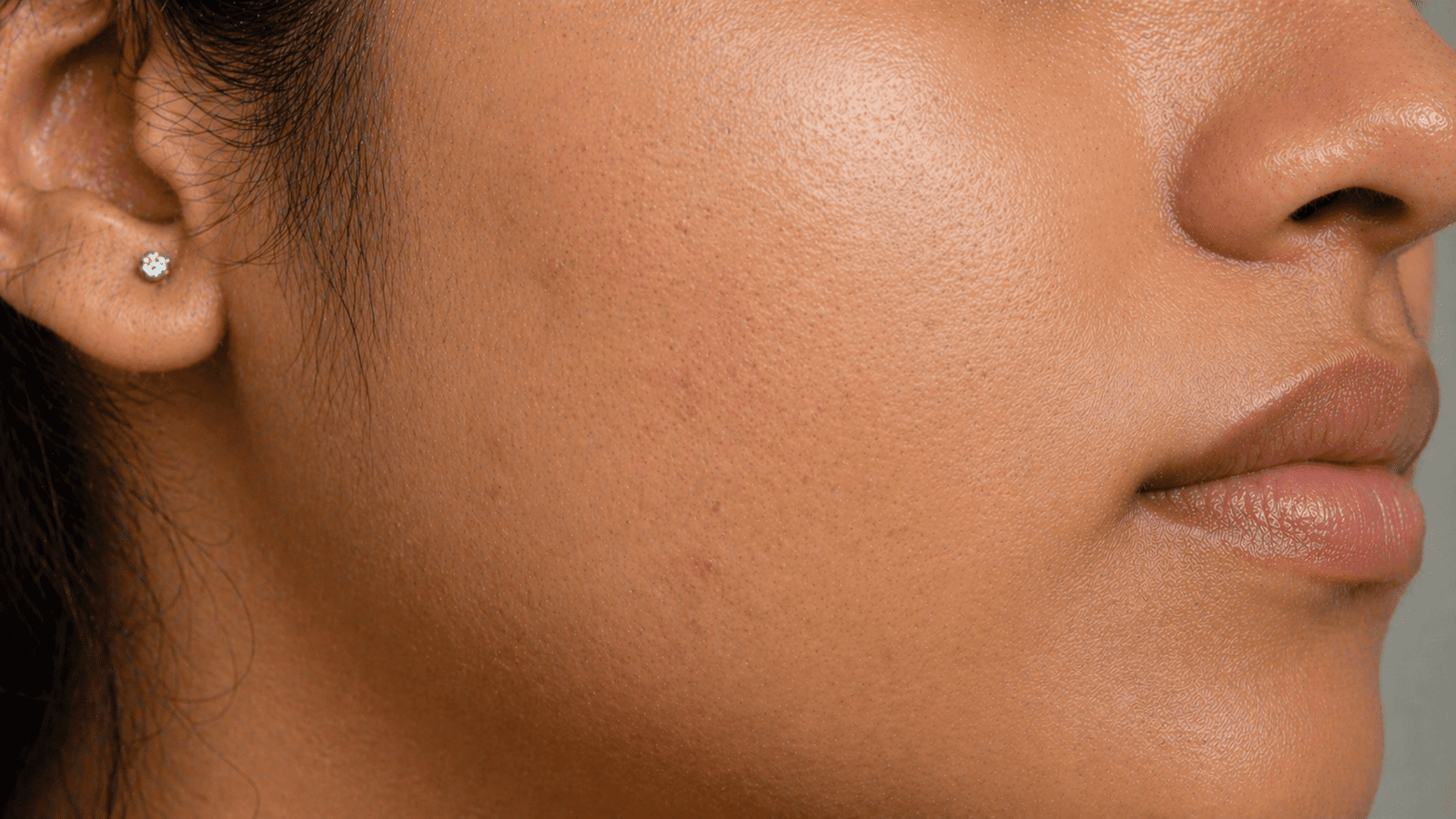 Clearer Indian skin with reduced acne and fading marks after treatment at Brilliance Cosmocare Skin, Hair and Weightloss Clinic in Mumbai, India