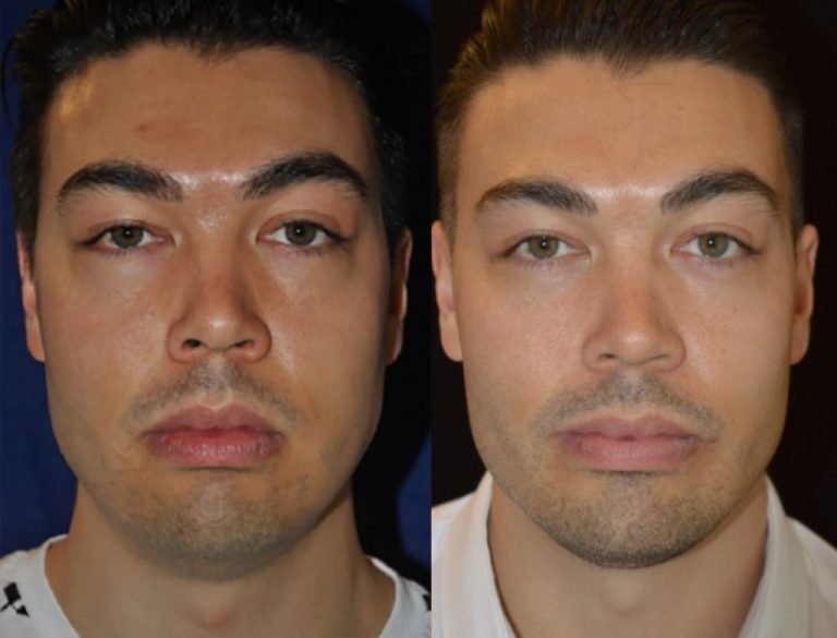 Chin Augmentation