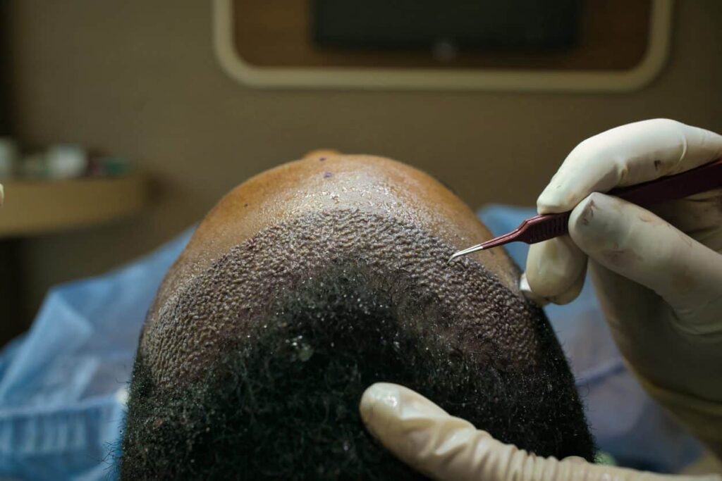 Direct Hair Implantation (DHI)