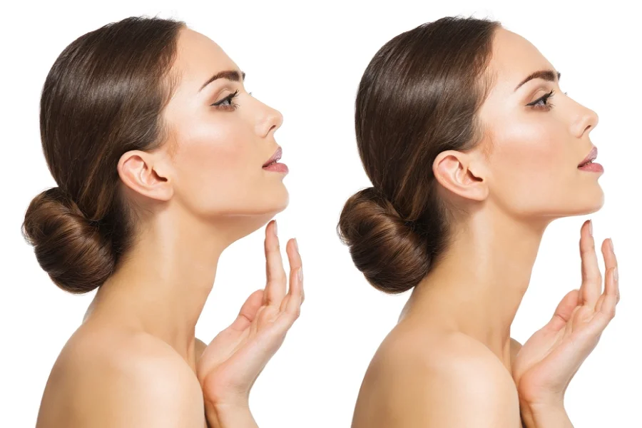 Double Chin Reduction