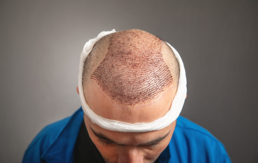 Hair Transplant (FUE)