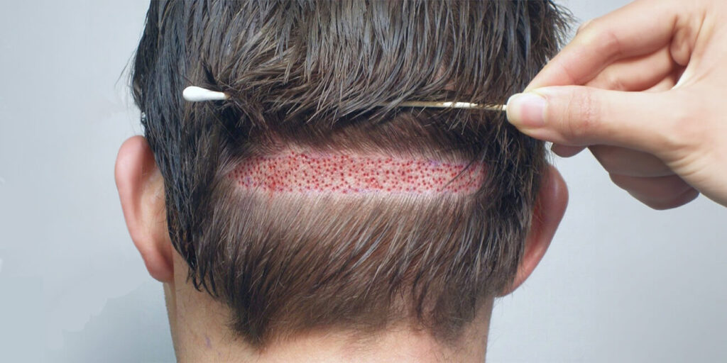 Hair Transplant (FUT)