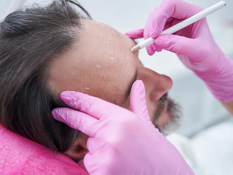Hairline Lowering Treatment