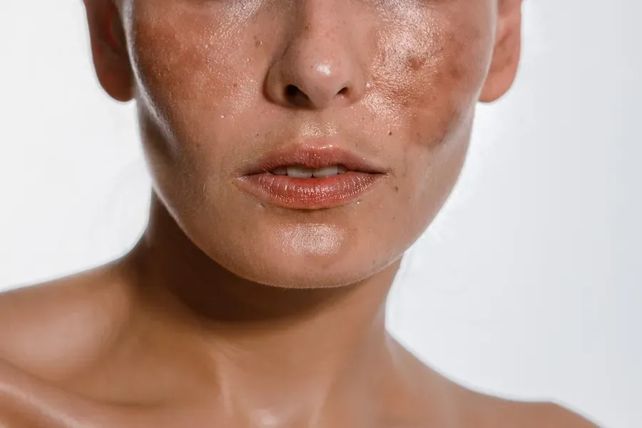 Laser Pigmentation Removal