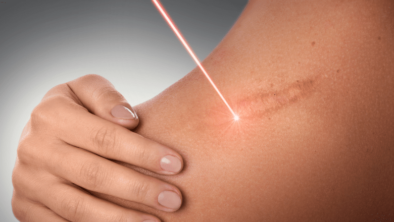 Laser Scar Treatment