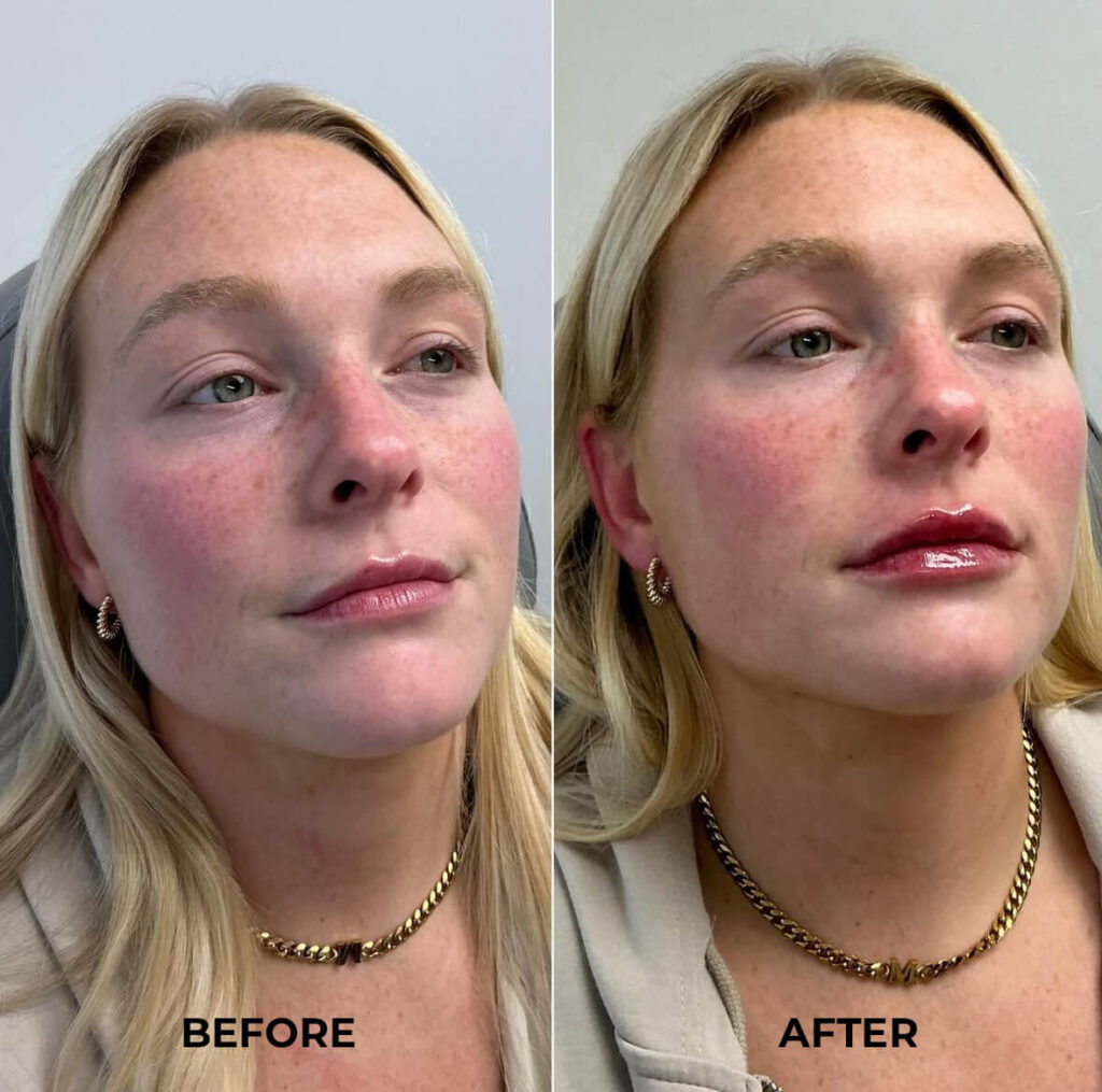 Lip Fillers
