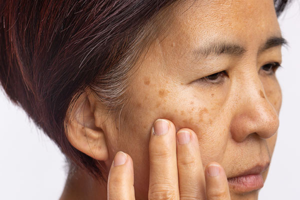 Melasma Treatment