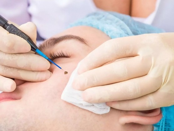 Mole Removal
