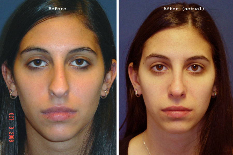 Non-Surgical Rhinoplasty