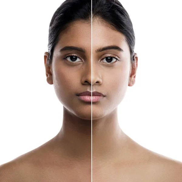 Skin Lightening Treatment