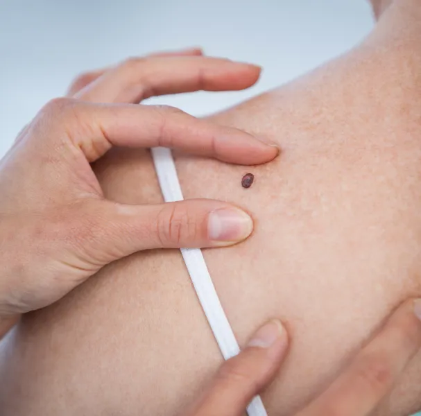 Skin Tag Removal Treatment