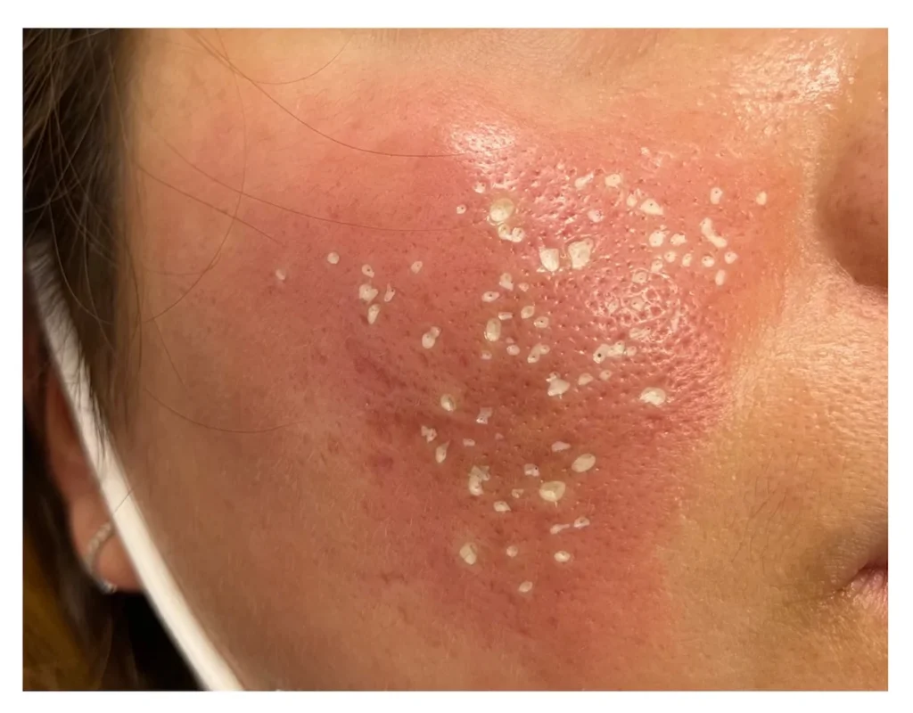 TCA CROSS Treatment